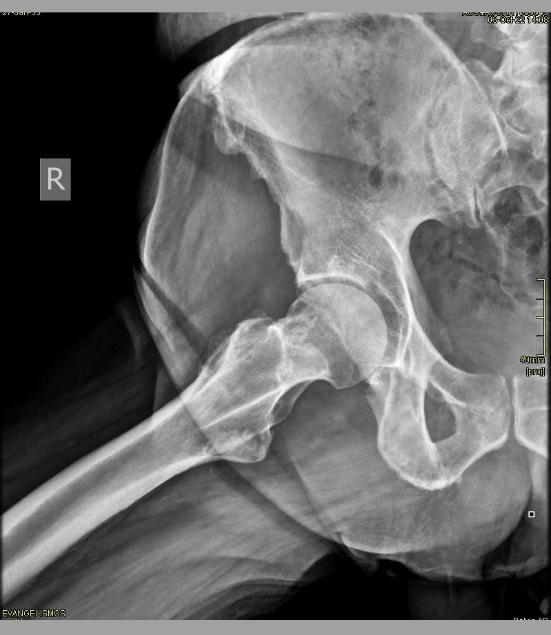 my hip x-ray